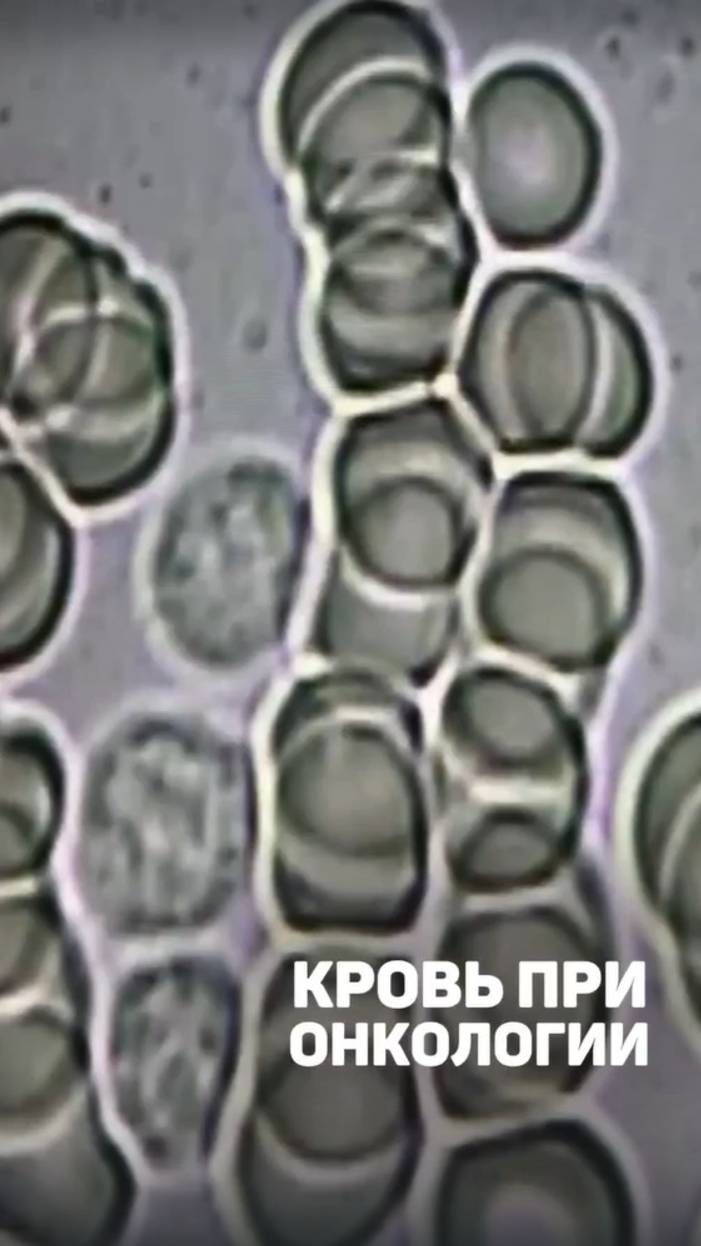 Так выглядит под микроскопом капля крови онкобольного. Алена Братишко смотреть онлайн