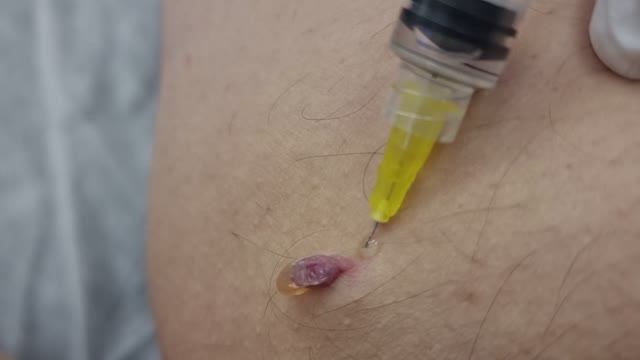 Удаление папилломы в клинике Чудо Доктор смотреть онлайн