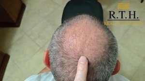 Две недели после пересадки волос: Что происходит?