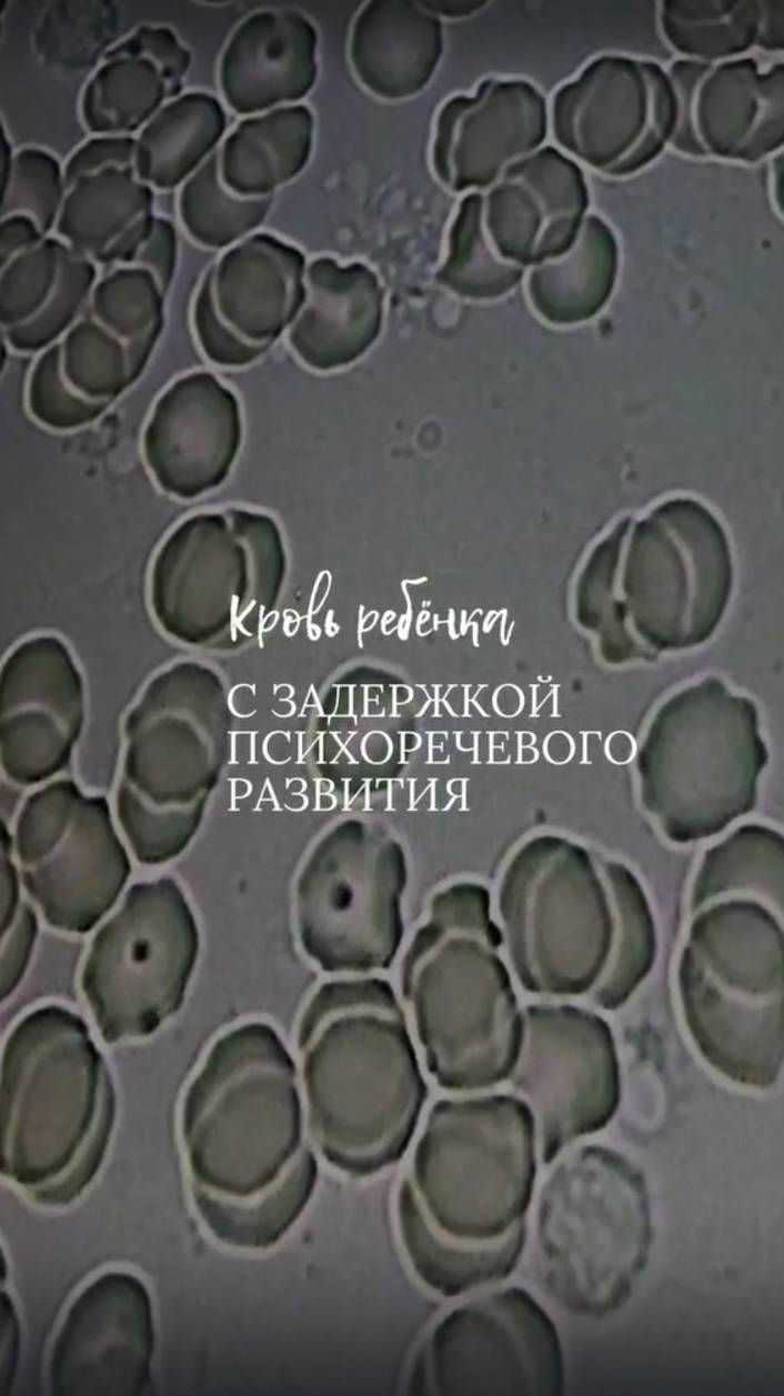 Кровь ребёнка с задержкой психоречевого развития смотреть онлайн
