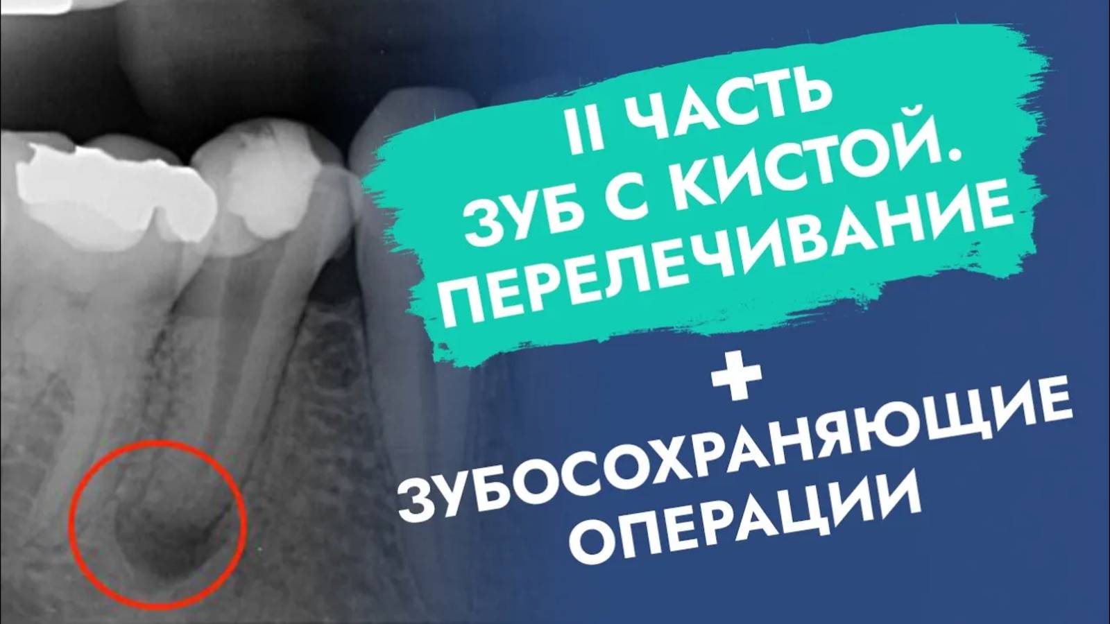 Если на корне зуба киста - это не приговор!