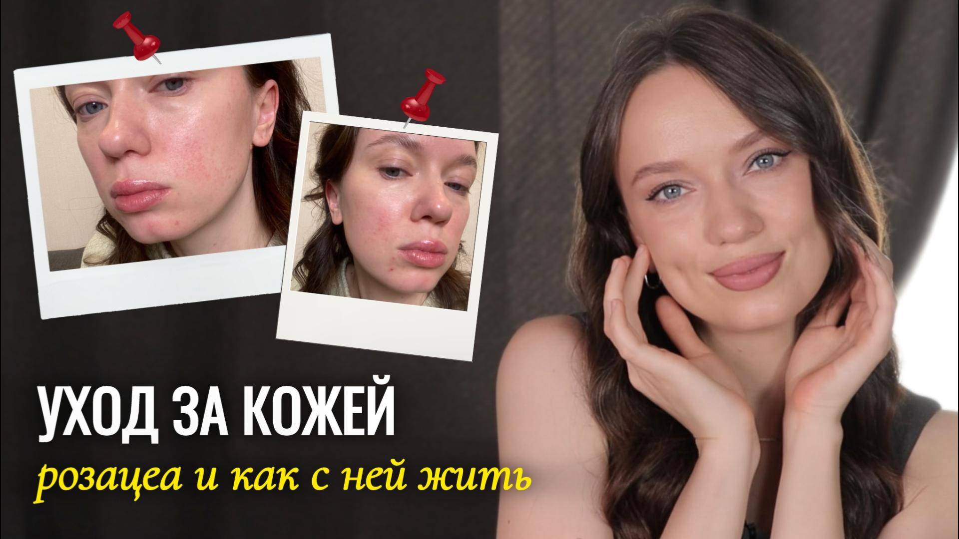 Уход за кожей лица | Уход за чувствительной кожей с розацеа смотреть онлайн