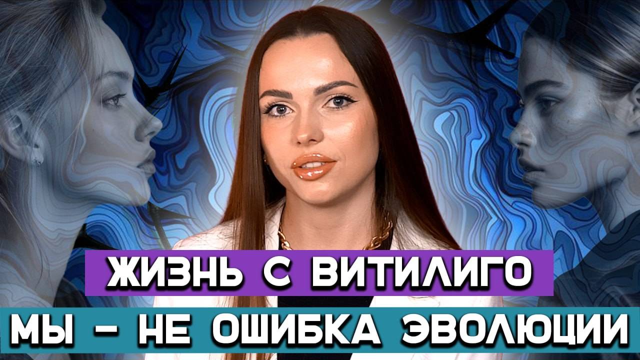Жизнь с витилиго. Как блогер превратила свою болезнь в успешное дело смотреть онлайн