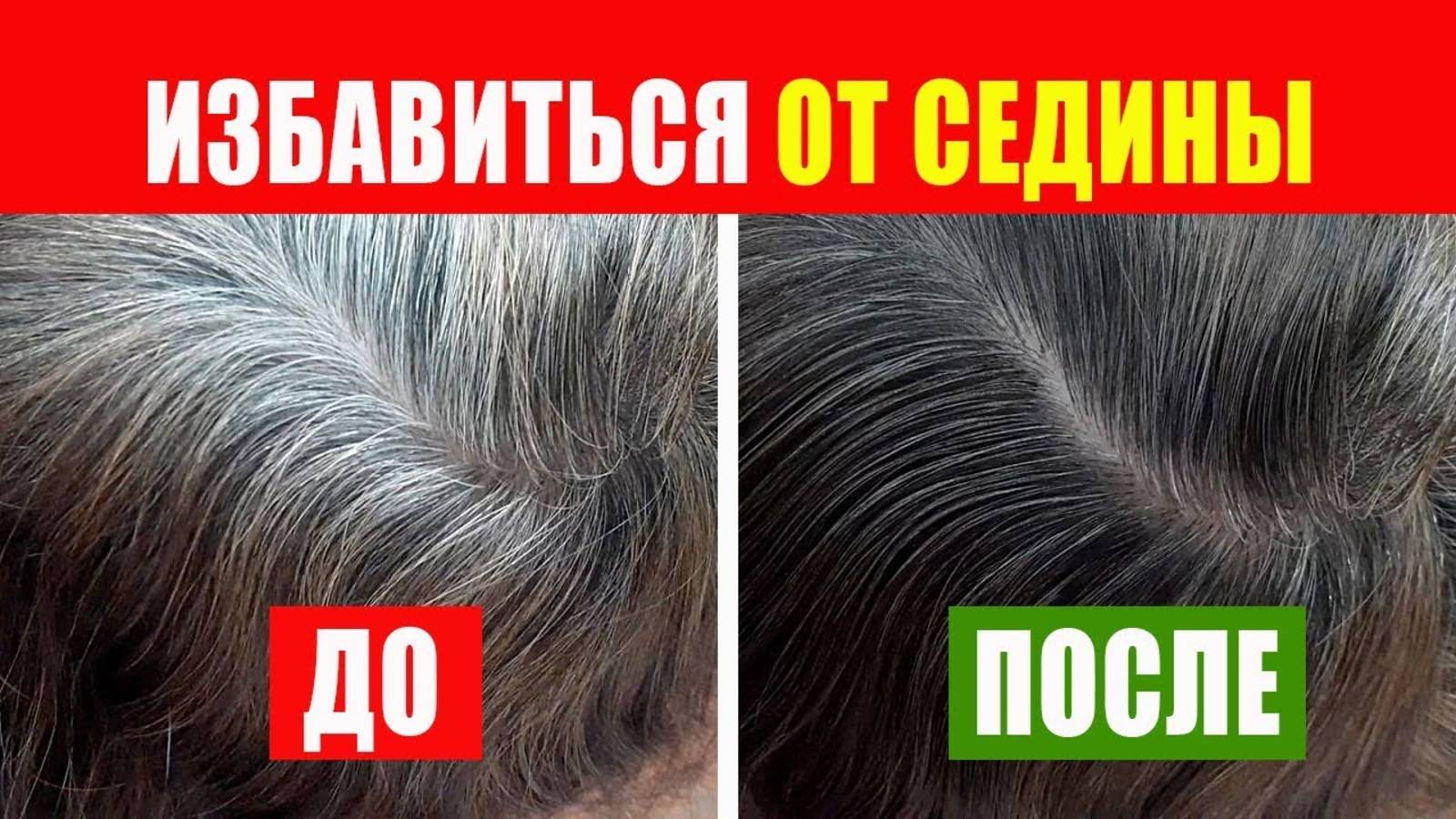 СЕДЫЕ ВОЛОСЫ Исчезнут навсегда! БЕЗ ОКРАШИВАНИЯ! Волосы растут как сумасшедшие и не выпадают! смотреть онлайн
