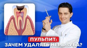 Пульпит: почему приходится удалять нерв зуба?