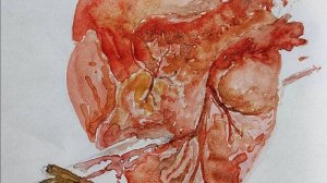 Гипертрофическая кардиомиопатия: причины, симптомы и современное лечение