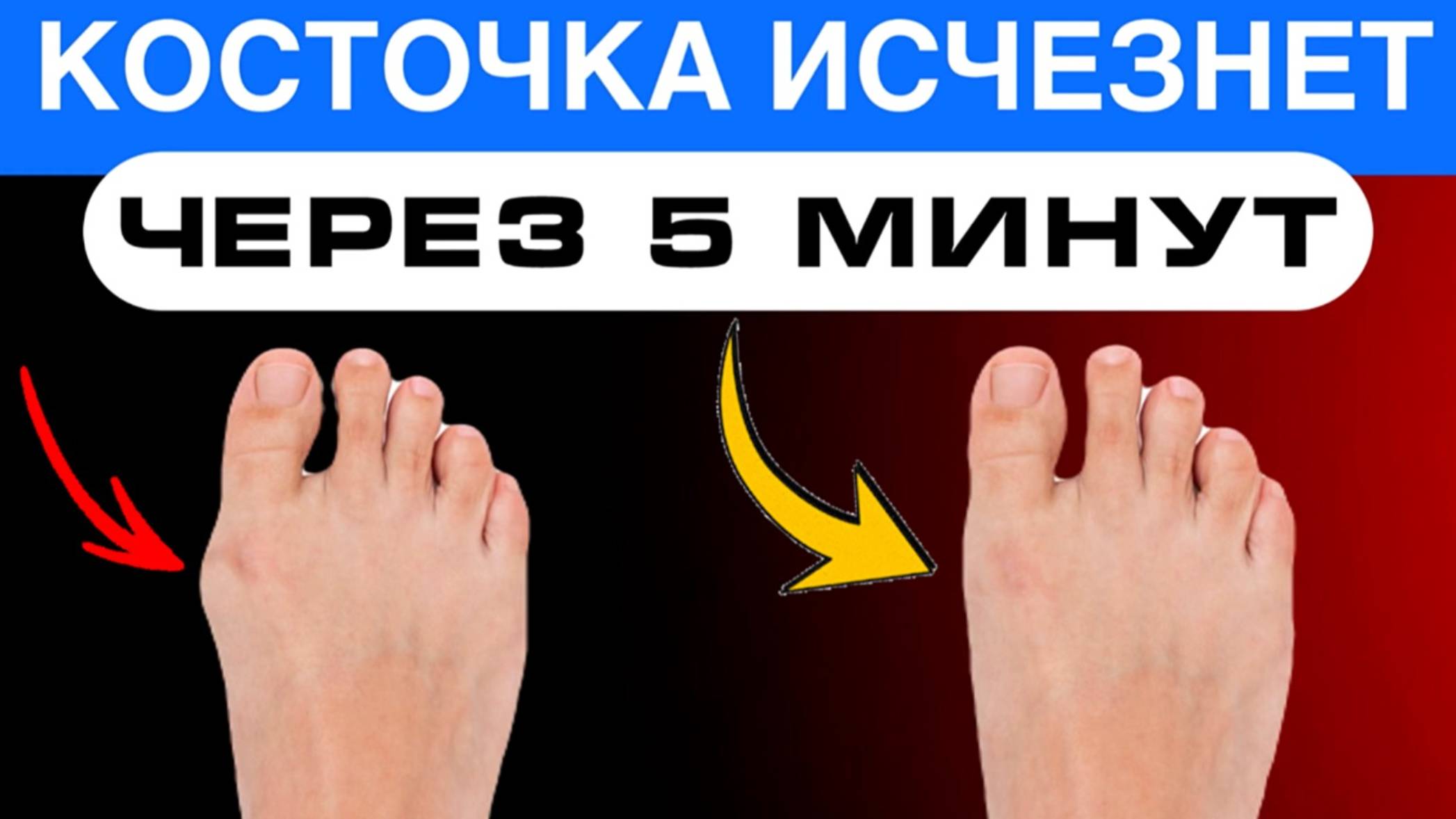 Как быстро убрать "косточку" на большом пальце смотреть онлайн