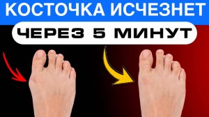 Как быстро убрать "косточку" на большом пальце