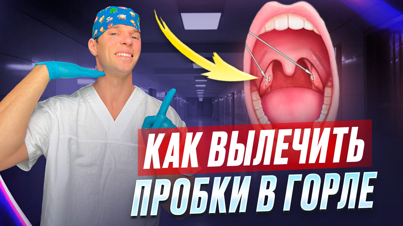 Белые пробки в ГОРЛЕ. Тонзиллит и лечение пробок в гландах. смотреть онлайн