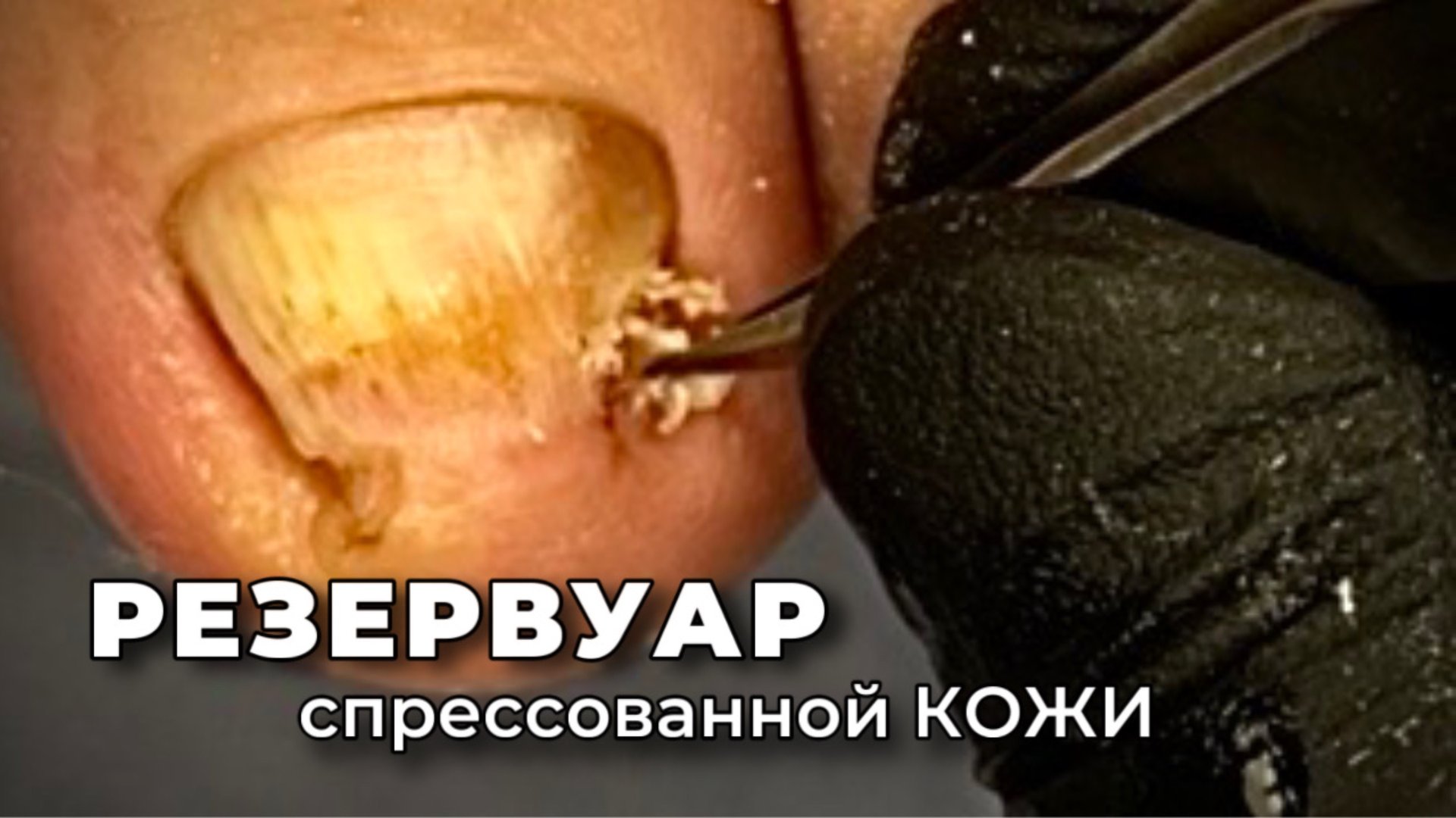 Пучение ногтевого ложа из-за давления боковых стенок смотреть онлайн