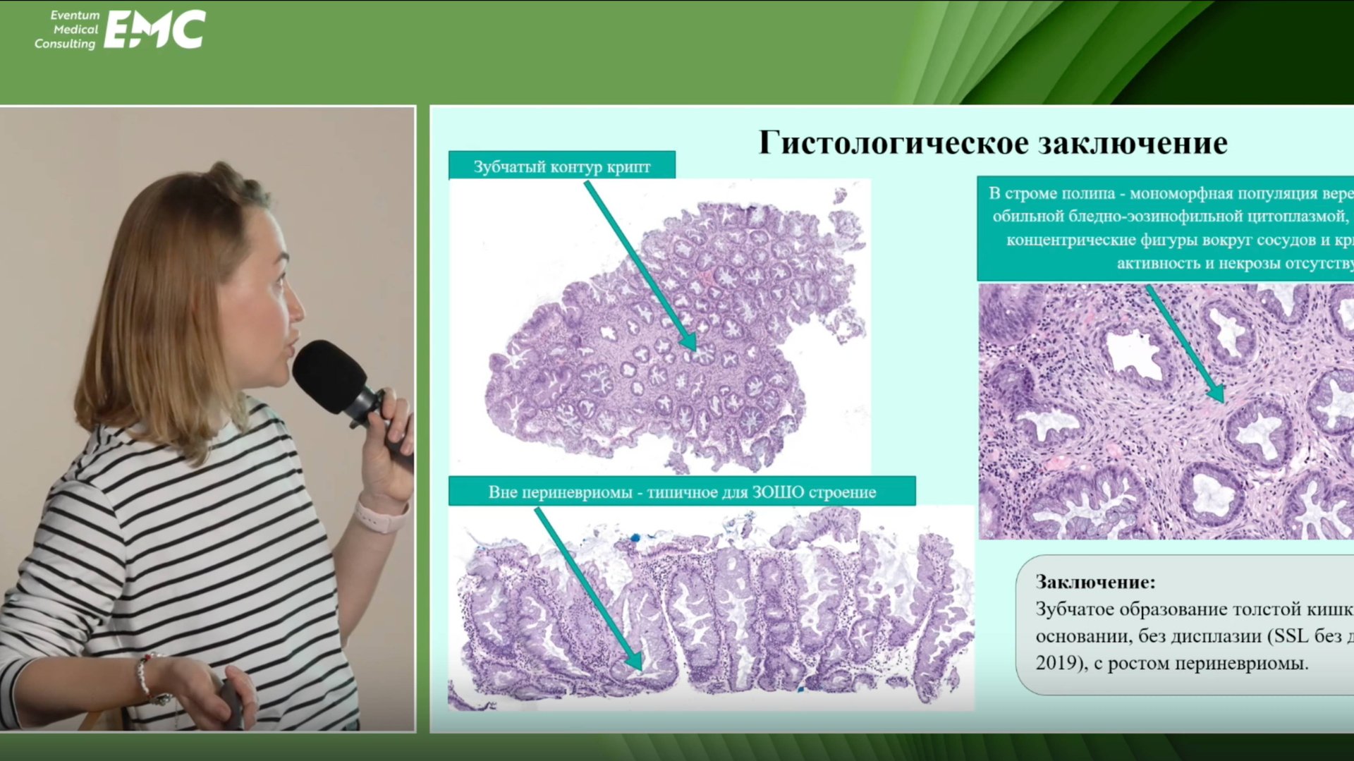 2. Гусева Е.В., Савицкая Т.А. Периневриомы - мезенхимальные опухоли толстой кишки.