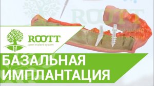 Одноэтапная базальная имплантация нижней челюсти с ИСПОЛЬзованием системы ROOTT