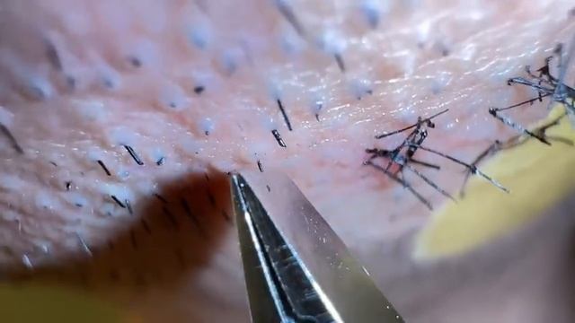 Удаление вросших волос из бороды #удалениеволос #вросшиеволосы #удалениевросшихволос