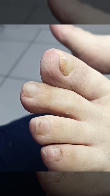 Нет это не стопа ДИАБЕТИКА, это стопа клиента который перенёс инсульт