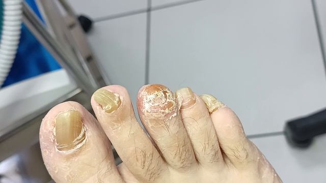 Онихогрифоз