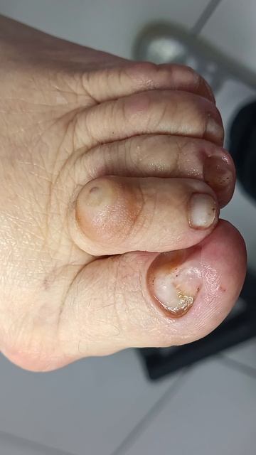 Результат после зачистки онихогрифоза