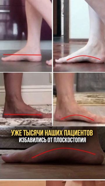 Пишите слово «Подход» и я пришлю вам подробную инструкцию, как раз и навсегда вылечить плоскостопие смотреть онлайн