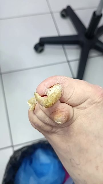 Онихогрифоз