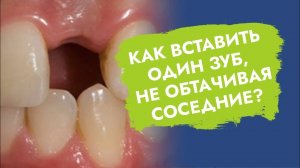 Методы протезирования одного утраченного зуба!