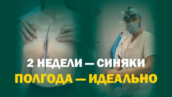 Увеличение груди 440 мл Mentor: результат через 6 месяцев