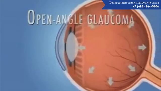 Первичная глаукома