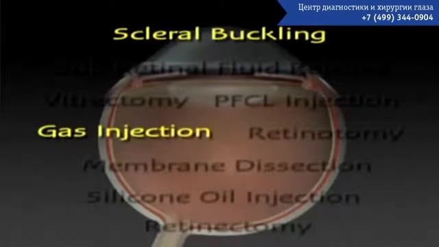 Отслоение сетчатки  Лечение