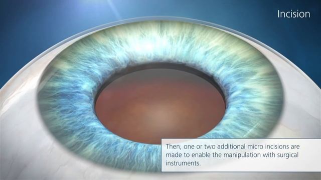 Катаракта и как ее лечат