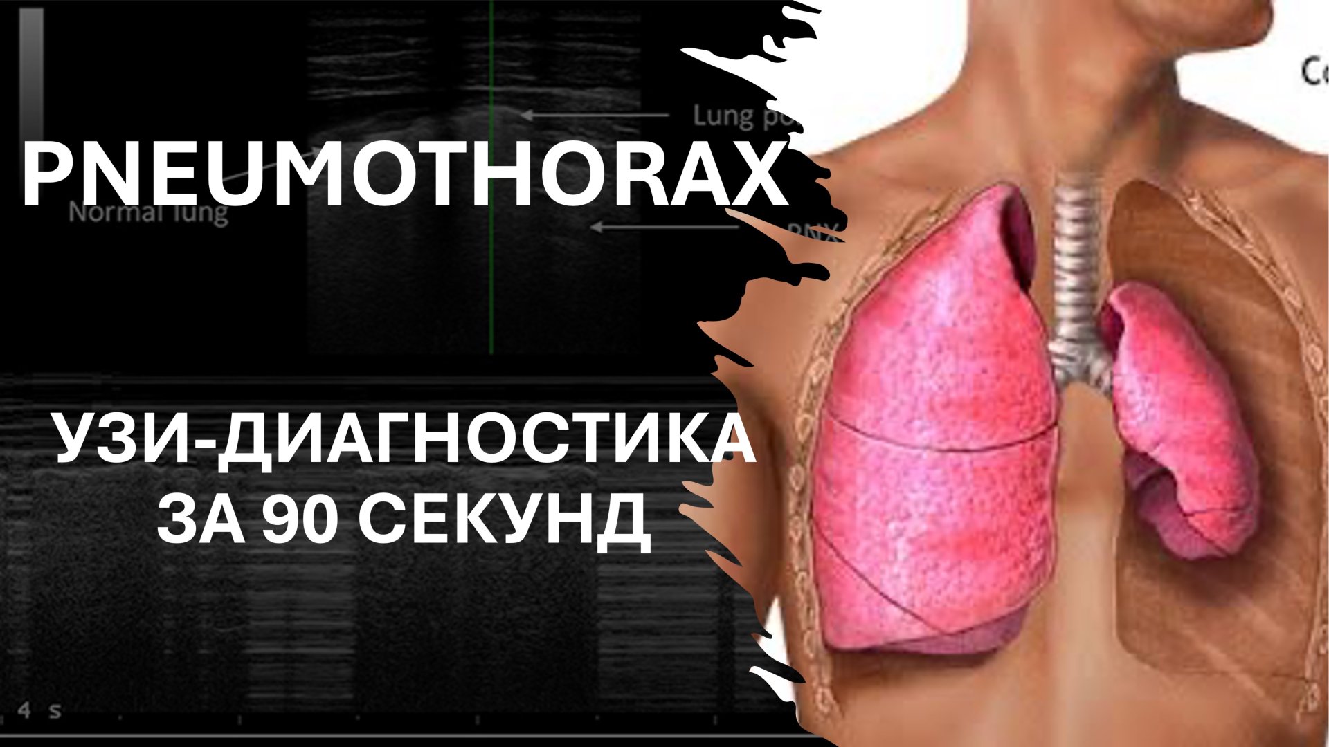 ПНЕВМОТОРАКС. ПРИКРОВАТНОЕ УЗИ ЗА 90 СЕКУНД #узи #ultrasound #emergency #pneumothorax
