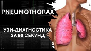 ПНЕВМОТОРАКС. ПРИКРОВАТНОЕ УЗИ ЗА 90 СЕКУНД #узи #ultrasound #emergency #pneumothorax