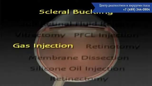 Отслоение сетчатки. Операция