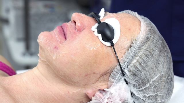 IPL Эфир, процедура