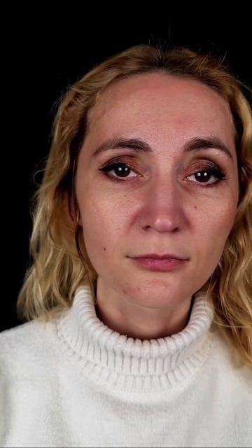 Пластика нижних век - видимый результат спустя 2 месяца после операции