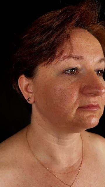 Пластика нижних век - до/после через 1 месяц после операции