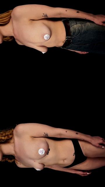 Подтяжка груди - ранний результат спустя 1 месяц после операции