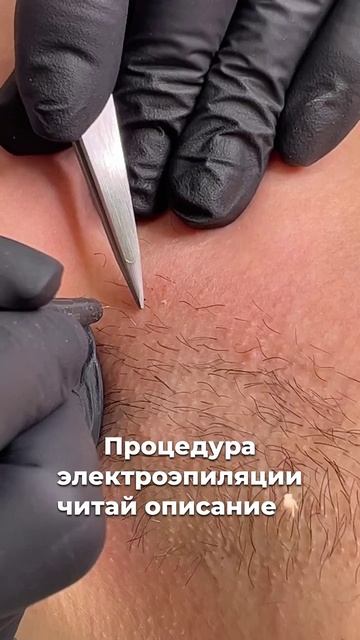 Электроэпиляция в сети студий депиляции WAX BAR. Единственный метод удаления волос - навсегда!