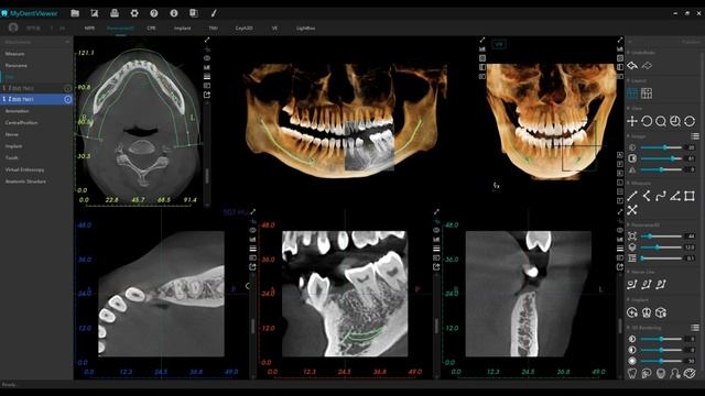 Meyer - 3D Panorama with Endo смотреть онлайн