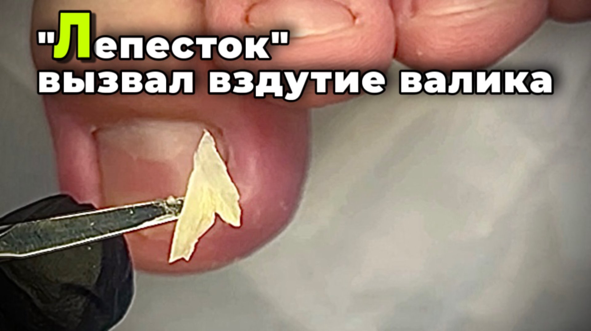 Преображение ногтя. Вернуть все как и должно быть смотреть онлайн