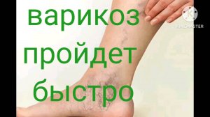 Варикоз ног- супер упражнения!