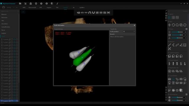 Meyer - 3D Orthodontics Auto CEPH Measurement смотреть онлайн