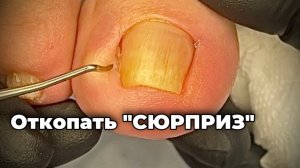 Найти продолжение ногтя глубоко в пазухе