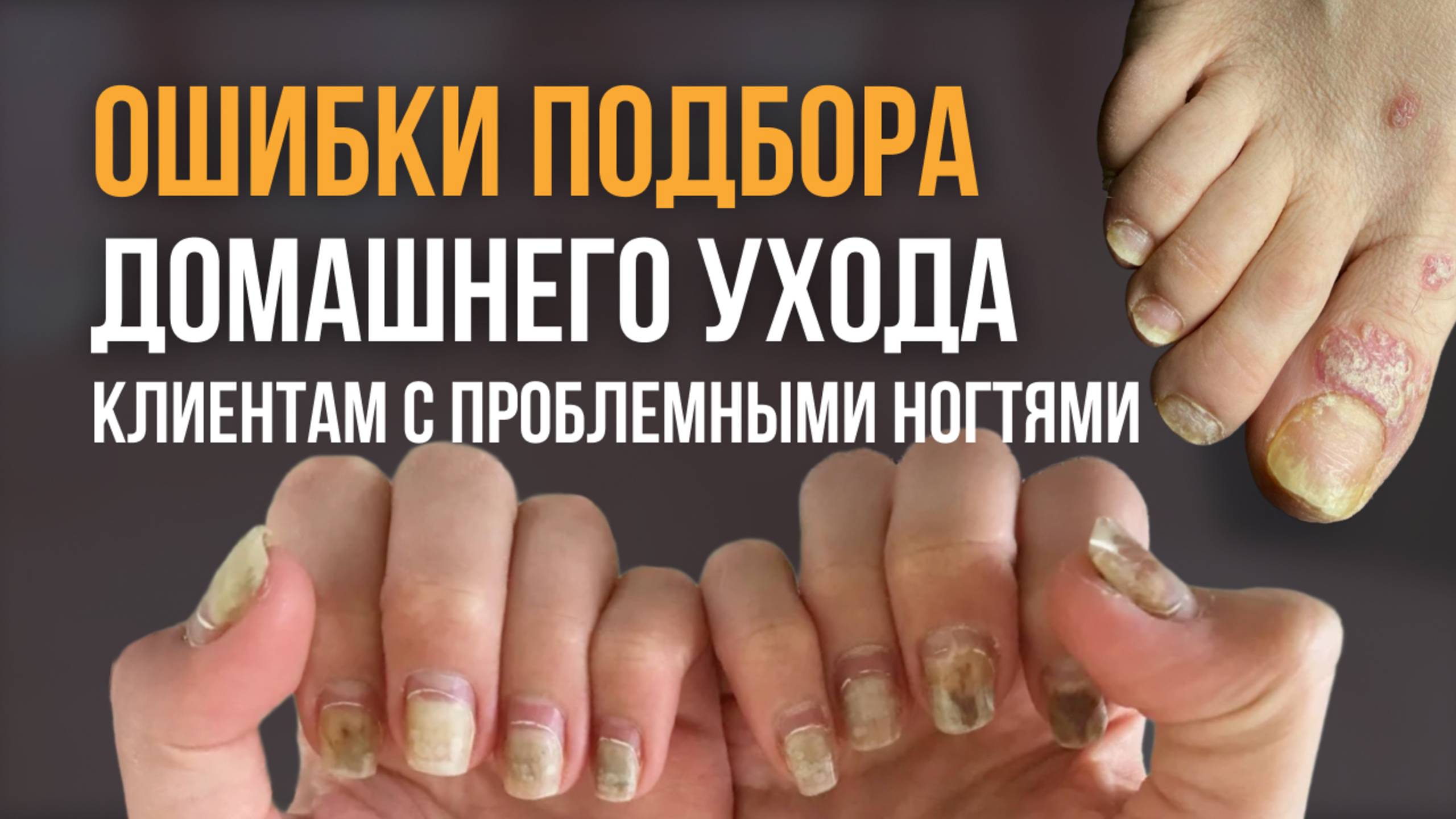 Уход за проблемными ногтями #ногти #подолог #подология #грибок #онихолизис