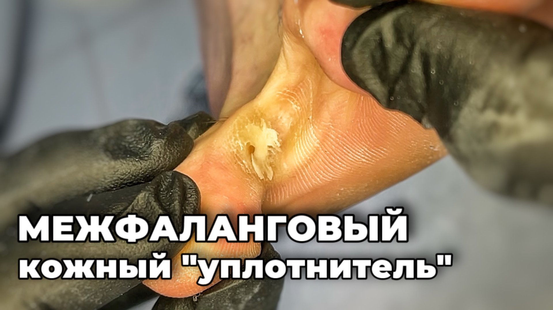 Ростки у основания межпальцевого пространства смотреть онлайн