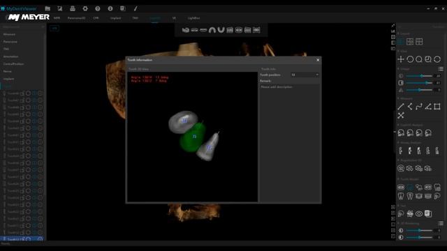 MEYER — Отчет об автоматическом измерении цефалометрии в ортодонтии MEC‑3D смотреть онлайн