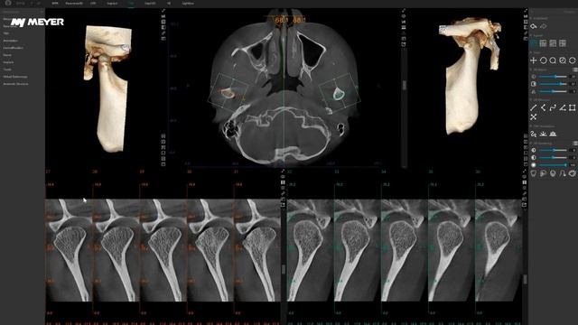 MEYER — Автоопределение ВНЧС