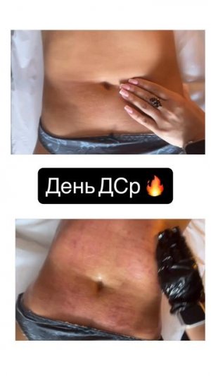 1 сеанс ДСР .