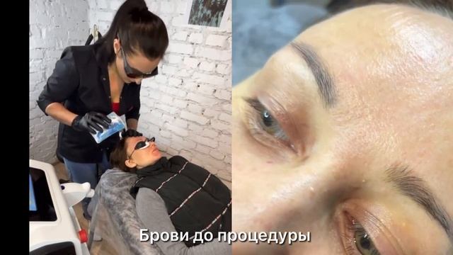 Процесс осветления некачественного татуажа смотреть онлайн