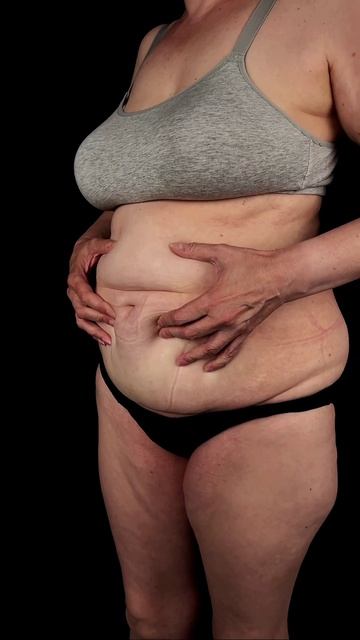 Липоабдоминопластика - результат спустя 1,5 месяца