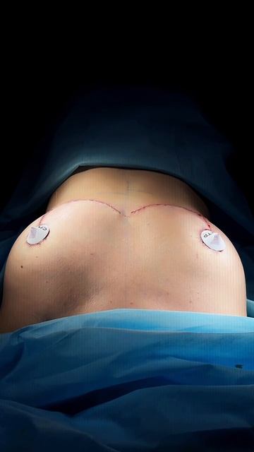 Удаление имплантов с одномоментной подтяжкой - результат сразу после операции