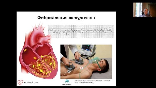 Аритмия. Часть 3. Желудочковые аритмии.