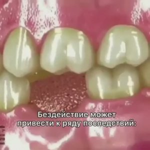 Что будет, если ничего не делать после удаления зуба?